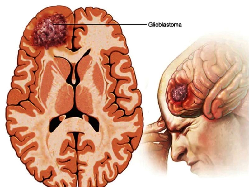 Triệu chứng của căn bệnh ung thư não