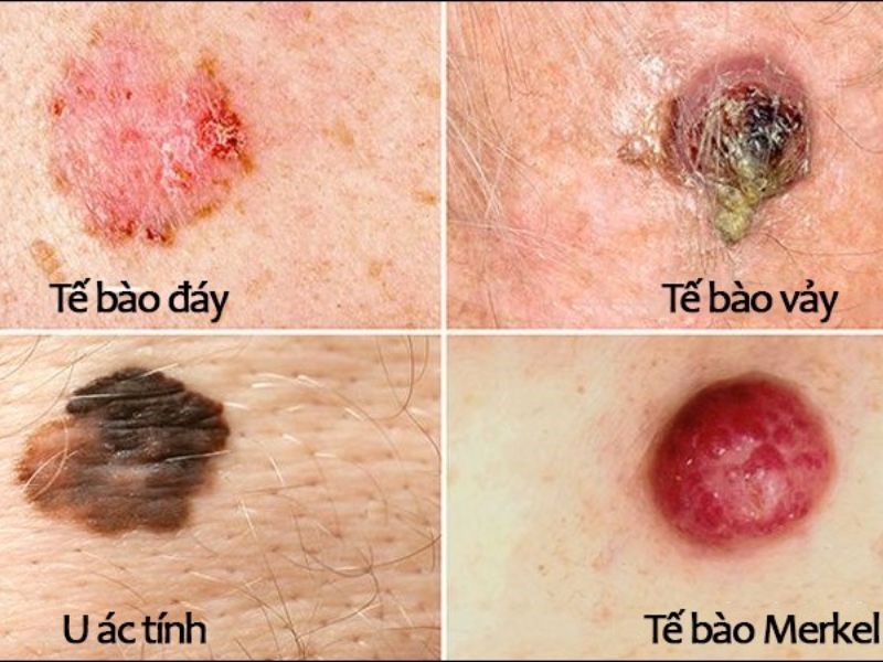 Tỷ lệ sống của bệnh nhân ung thư da phụ thuộc vào nhiều yếu tố