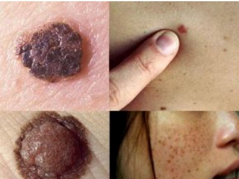 Ung thư da giai đoạn cuối sống được bao lâu?