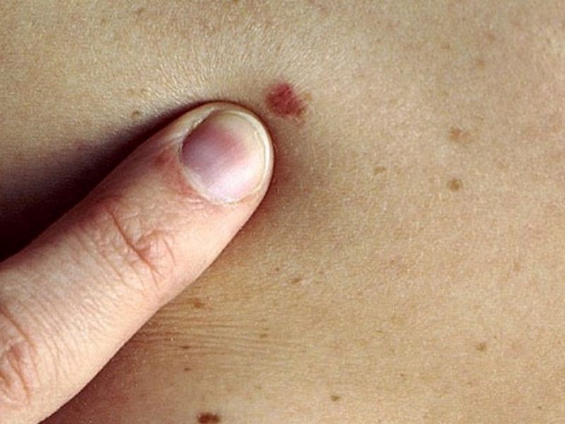 Ung thư da giai đoạn đầu