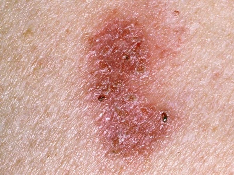 Ung thư da sống được bao lâu?