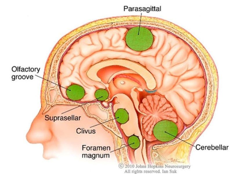 Ung thư não giai đoạn cuối sống được bao lâu?