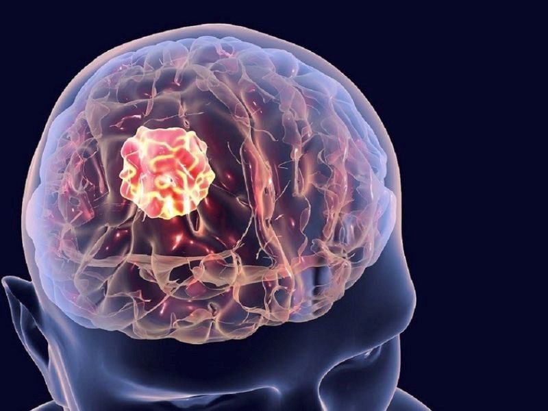 Ung thư não là căn bệnh rất nguy hiểm