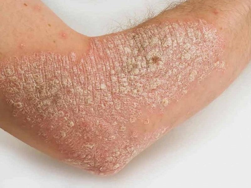 Xuất hiện những lớp da khô ráp, đóng vảy