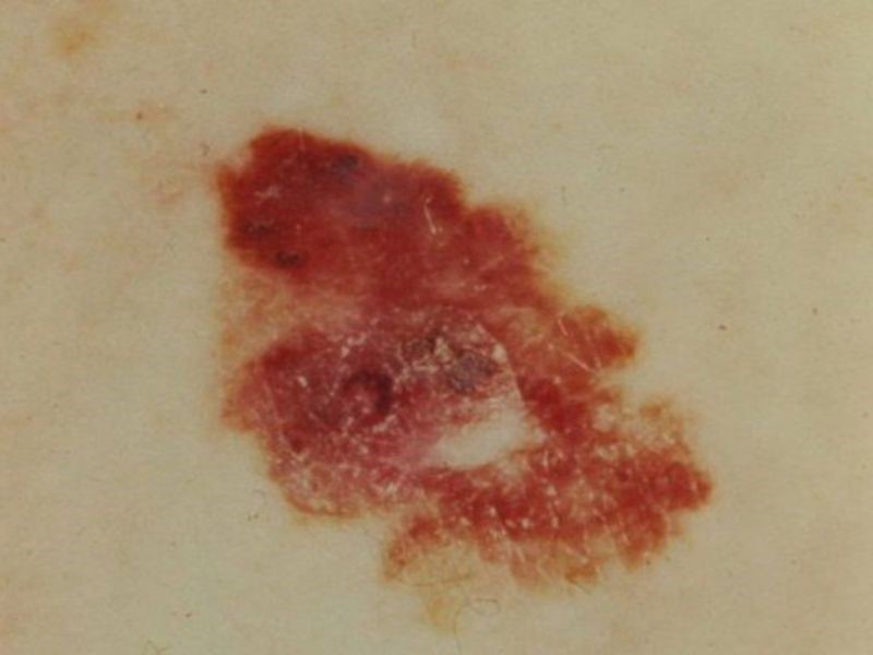 Xuất hiện những vết thương có viền không rõ ràng