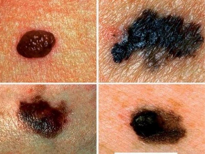 Xuất hiện nốt ruồi bất thường