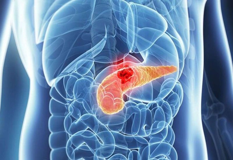 Bệnh nhân ung thư tuyến tụy cần có chế độ dinh dưỡng khoa học và phù hợp