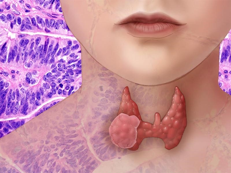 Nhung-doi-tuong-co-nguy-co-mac-ung-thu-tuyen-giap-the-nang