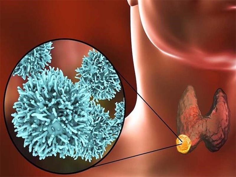 Ung-thu-tuyen-giap-the-nang
