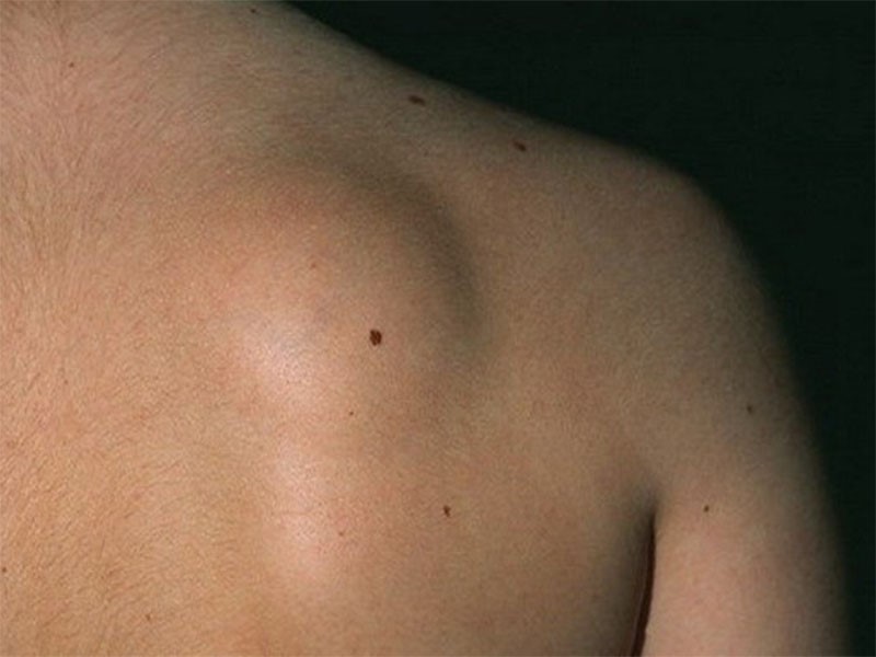 Các triệu chứng của u tuyến bã