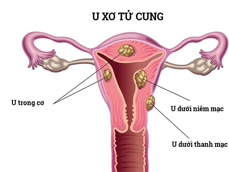 Căn bệnh u xơ tử cung