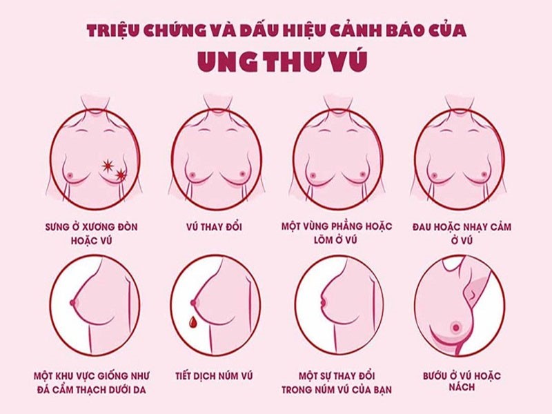 Dấu hiệu ung thư vú giai đoạn 2