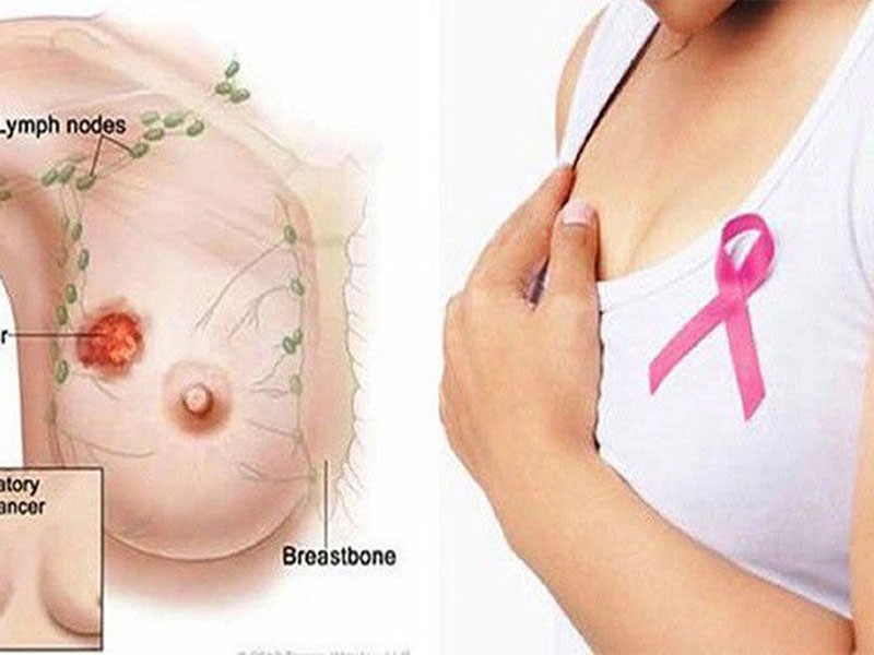 Đau nhức ngực là dấu hiệu đầu tiên của bệnh ung thư vú