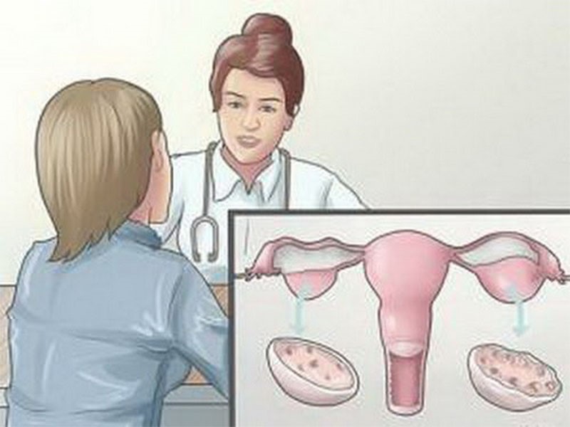 Điều trị căn bệnh u nang buồng trứng