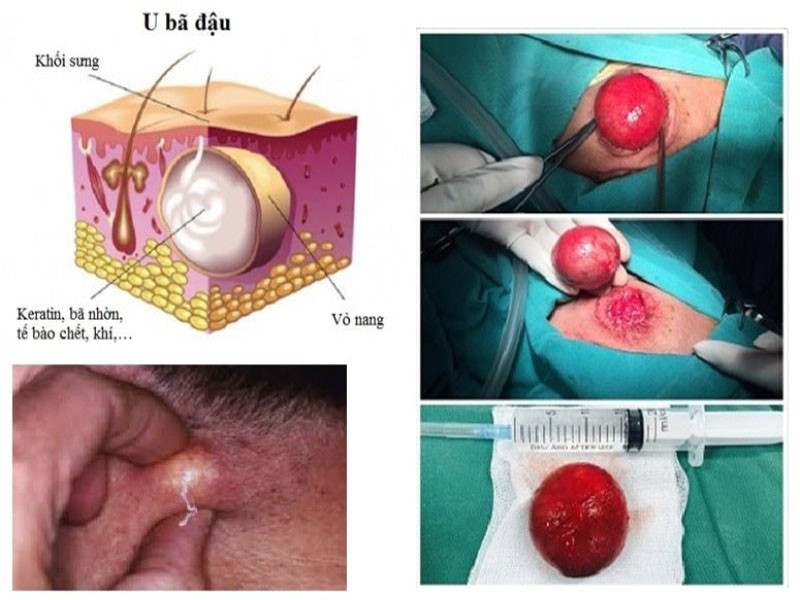 Điều trị u bã đậu