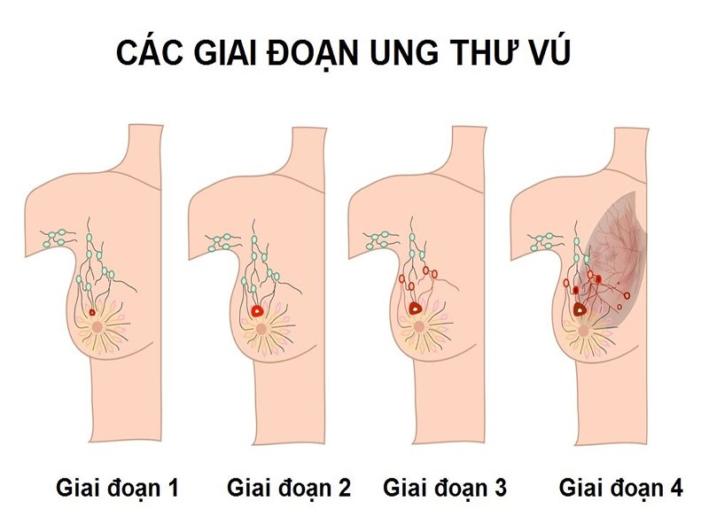 Giai đoạn ung thư vú