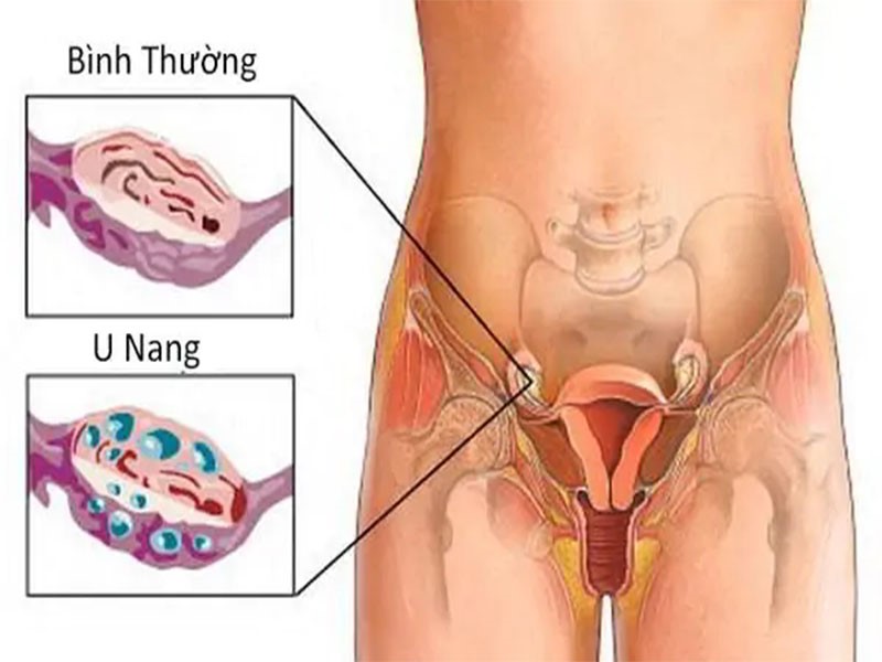 Nguyên nhân gây u nang buồng trứng