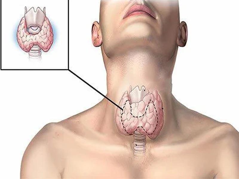 Biểu hiện lâm sàng của căn bệnh ung thư biểu mô tuyến giáp thể nhú