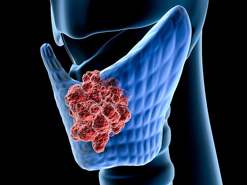 Các nguyên nhân gây nên căn bệnh ung thư tuyến giáp