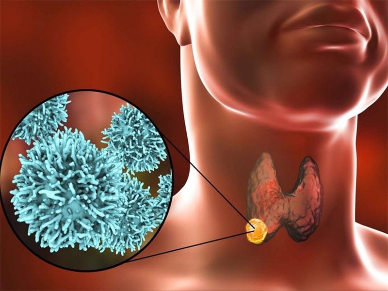 Nguyên nhân của căn bệnh ung thư biểu mô tuyến giáp thể nhú