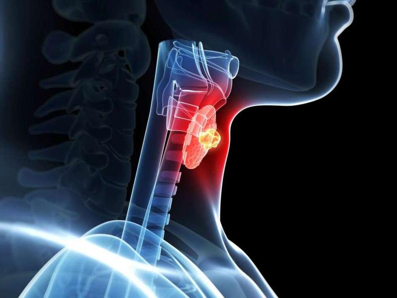 Ung thư biểu mô tuyến giáp thể nhú