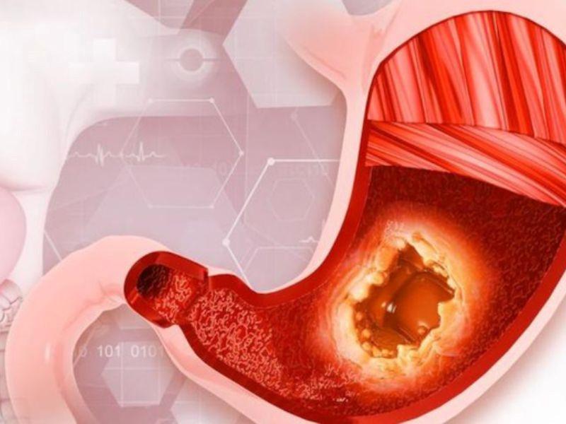 Căn bệnh ung thư dạ dày giai đoạn đầu