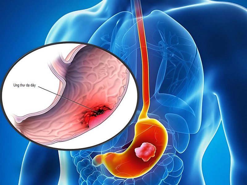 Căn bệnh ung thư dạ dày rất nguy hiểm
