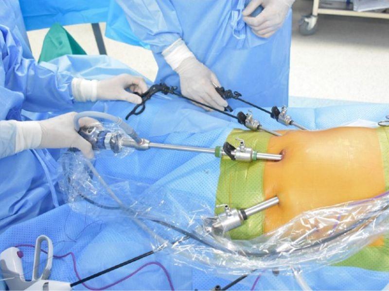 Cần tìm hiểu rõ chi phí phẫu thuật ung thư dạ dày để có kế hoạch hợp lý