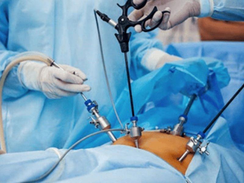 Có nhiều yếu tố ảnh hưởng tới chi phí phẫu thuật ung thư dạ dày