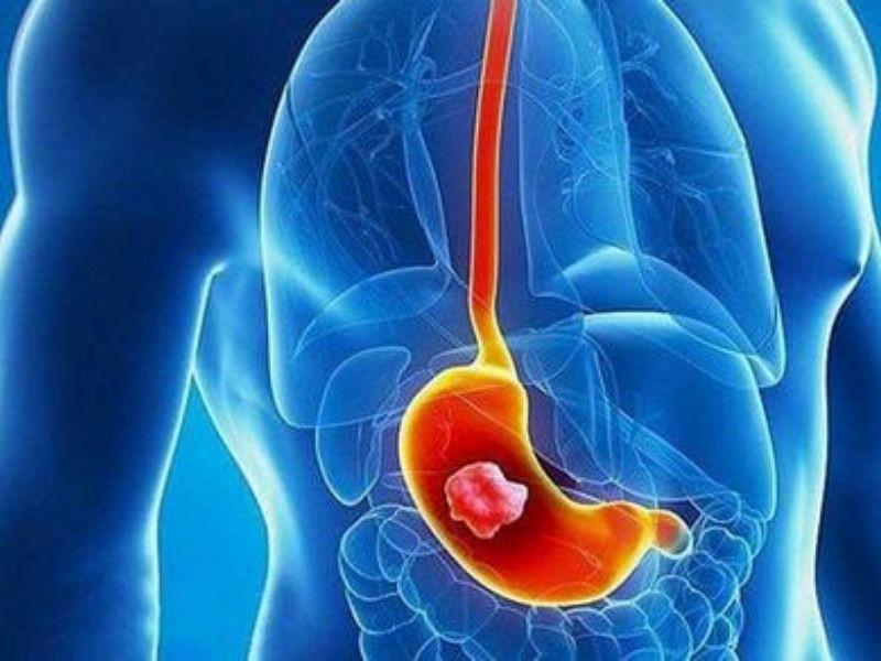 Phương pháp chẩn đoán ung thư dạ dày giai đoạn sớm