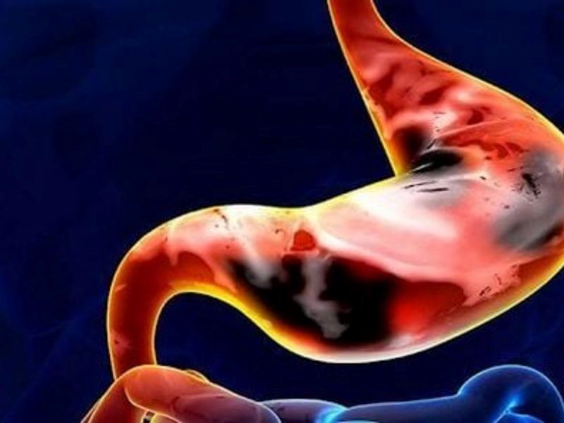 Triệu chứng của căn bệnh ung thư dạ dày giai đoạn cuối