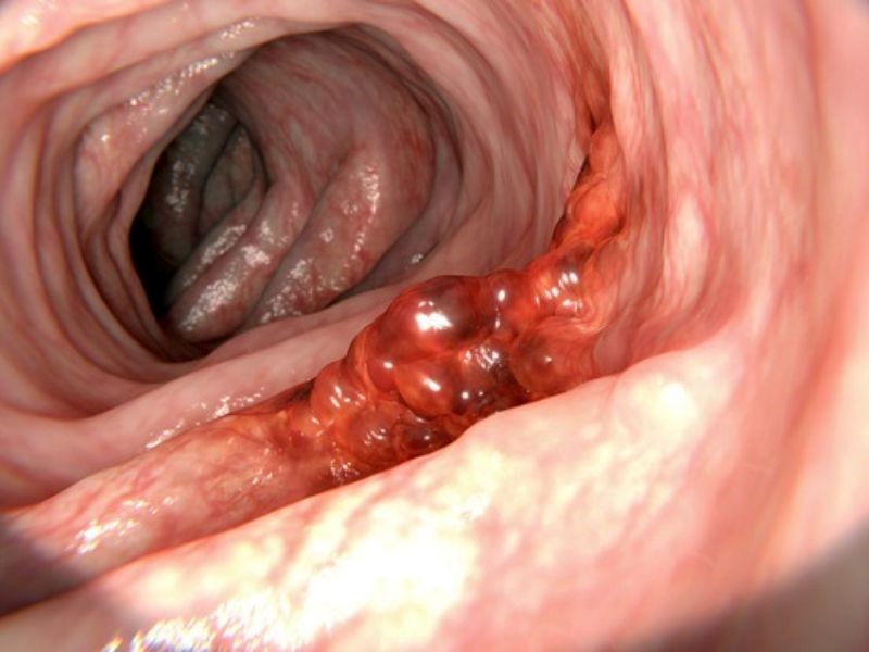 Tỷ lệ sống của bệnh nhân khi mắc ung thư dạ dày giai đoạn cuối