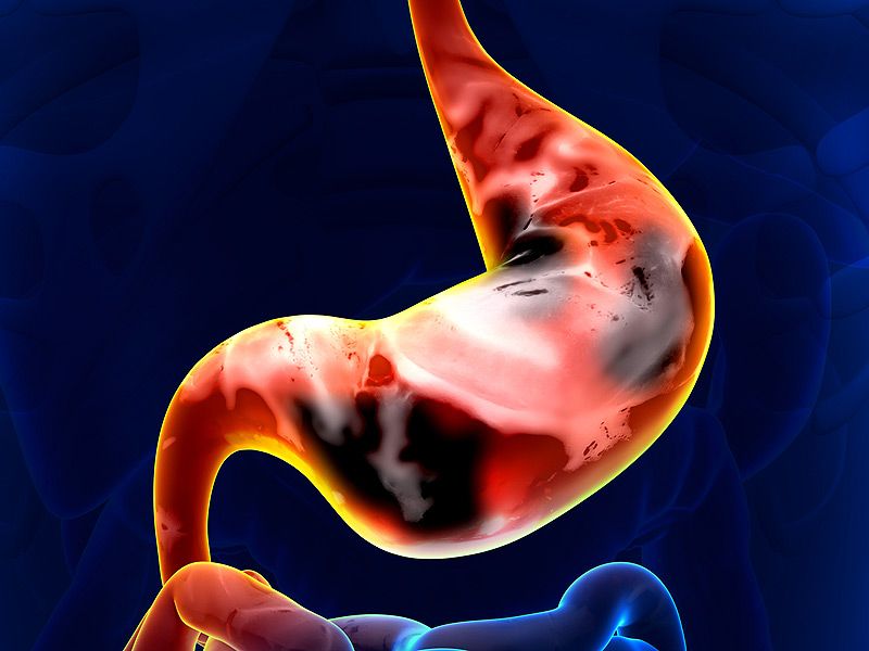 Ung thư dạ dày có chữa được không?