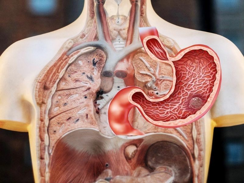 Ung thư dạ dày di căn tới nhiều bộ phận trong cơ thể