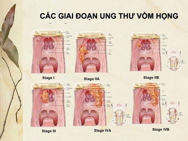Ung thư vòm họng có 4 giai đoạn chính, mỗi giai đoạn có những đặc điểm khác nhau