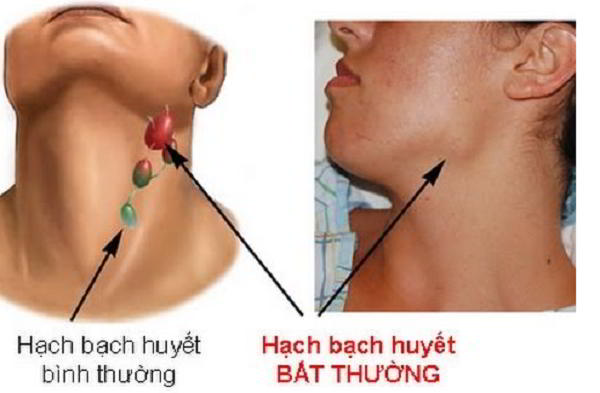 Ung thư vòm họng đa phần hay nổi hạch tại hạch bạch huyết.